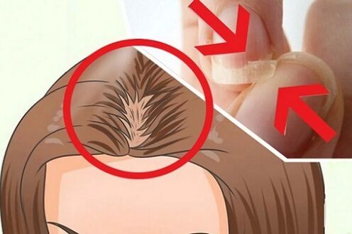 Problèmes de cheveux et d'ongles dus à des parasites